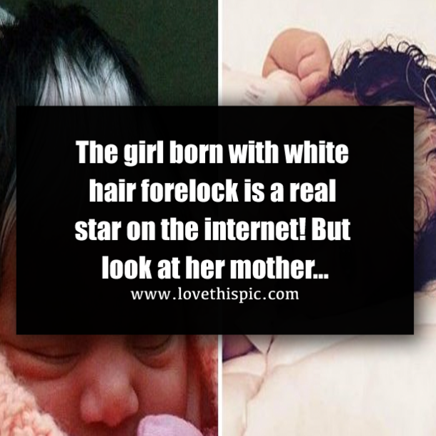 The Girl Born With White Hair Forelock Is A Real Star On The