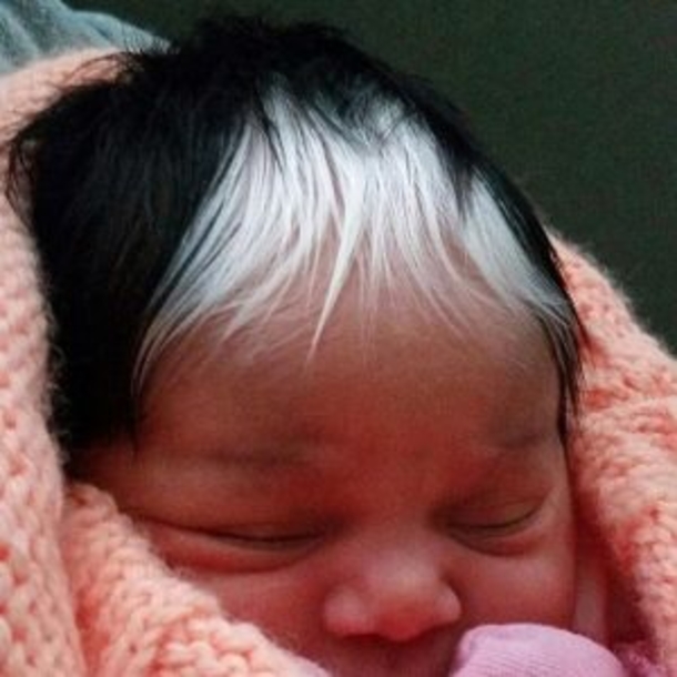 The Girl Born With White Hair Forelock Is A Real Star On The